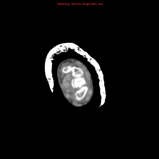 Brown tumor (Radiopaedia 12460-12694 Axial non-contrast 12).jpg