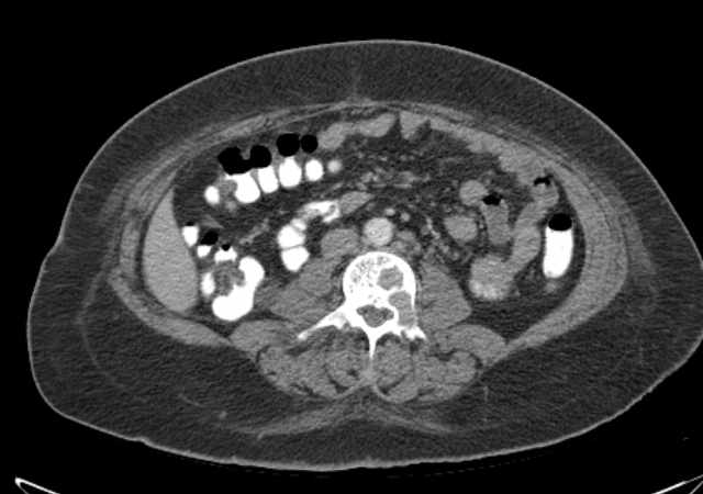 Brown tumors compressing the spinal cord (Radiopaedia 68442-77988 E 66).jpg