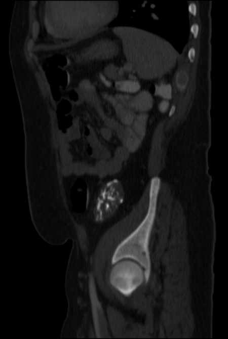 Brown tumors compressing the spinal cord (Radiopaedia 68442-77988 H 42).jpg