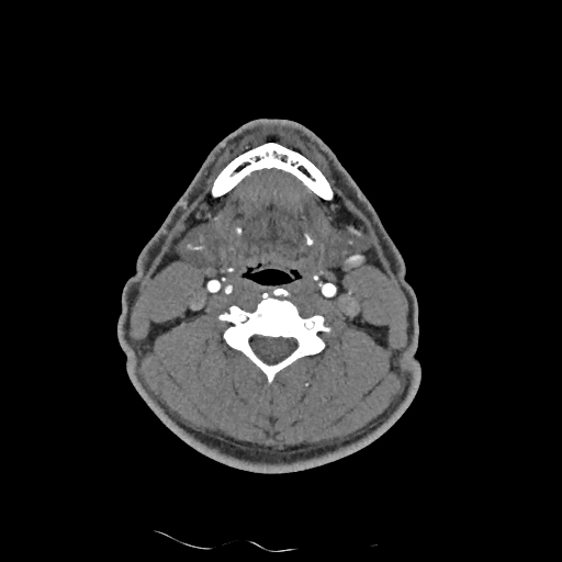 Buccal fat pad arteriovenous malformation (Radiopaedia 70936-81144 D 141).jpg