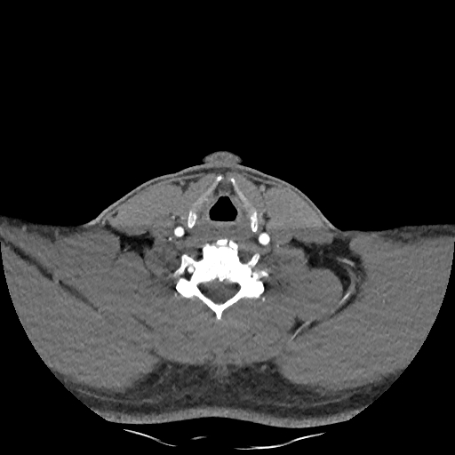 Buccal fat pad arteriovenous malformation (Radiopaedia 70936-81144 D 99).jpg