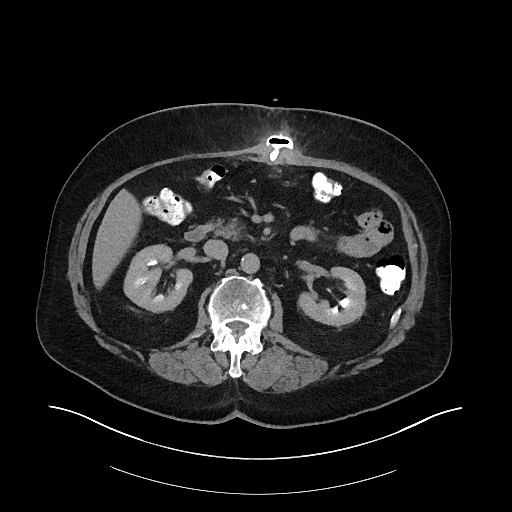 File:Buried bumper syndrome - gastrostomy tube (Radiopaedia 63843-72575 Axial Inject 12).jpg