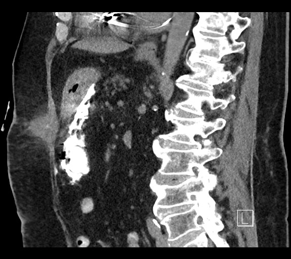 Buried bumper syndrome - gastrostomy tube (Radiopaedia 63843-72577 Sagittal Inject 53).jpg