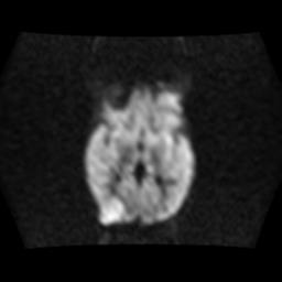 File:Burkitt lymphoma of the orbit- pre and post chemotherapy (Radiopaedia 31214-31929 Axial DWI 8).jpg