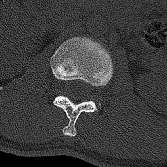Burst fracture (Radiopaedia 53373-59357 Axial bone window 15).jpg