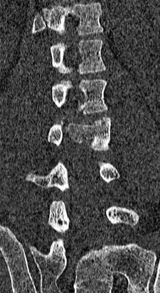 File:Burst fracture (Radiopaedia 53373-59357 Coronal bone window 44).jpg