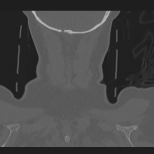 C2 fracture (Radiopaedia 34091-35341 Coronal bone window 59).png