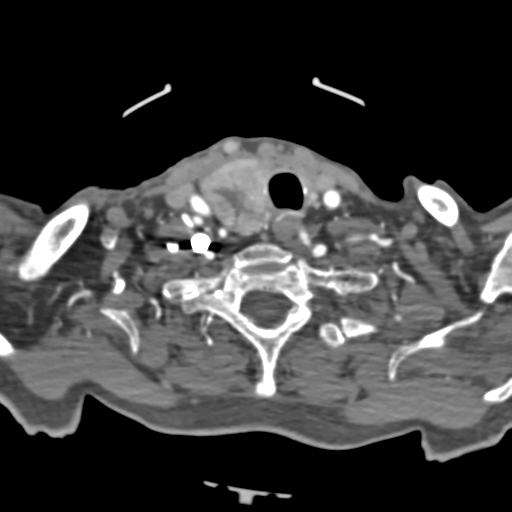 File:C2 fracture with vertebral artery dissection (Radiopaedia 37378-39200 A 83).png