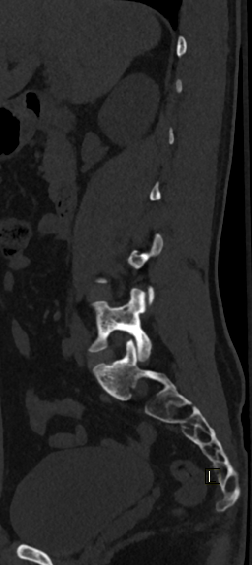 Calcaneal fractures with associated L2 burst fracture (Radiopaedia 71671-82493 Sagittal bone window 59).jpg