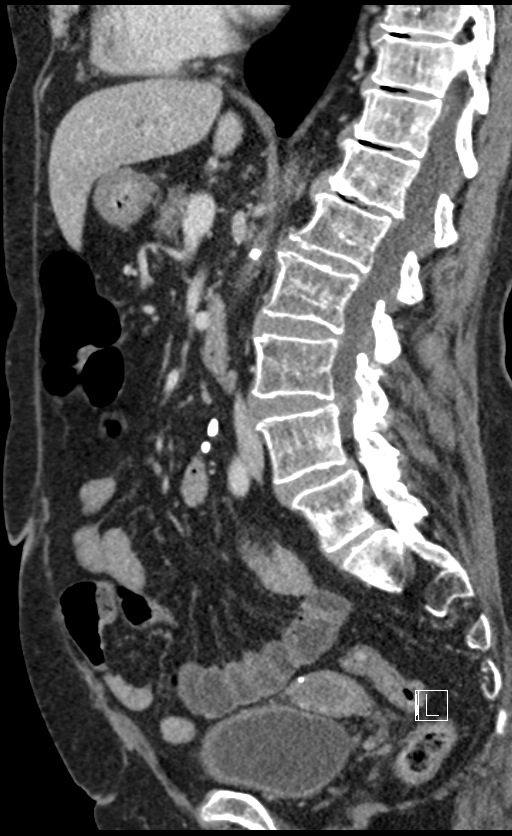 Calcified adrenal glands and Spigelian hernia (Radiopaedia 49741-54988 C 86).jpg