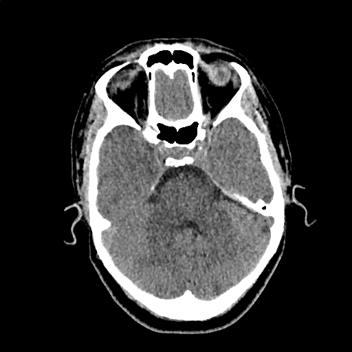 File:Calcified cerebral hydatid cyst (Radiopaedia 65603-74717 Axial non-contrast 16).jpg