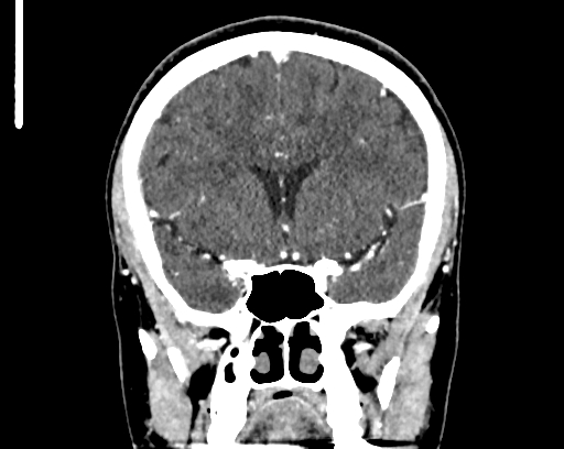 Calcified cerebral hydatid cyst (Radiopaedia 65603-74717 C 25).jpg