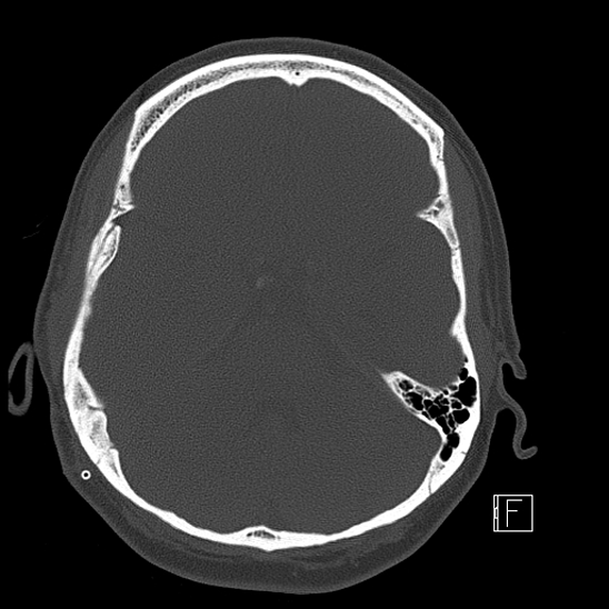 Calcified chronic subdural hematoma (Radiopaedia 77374-89492 Axial bone window 42).jpg