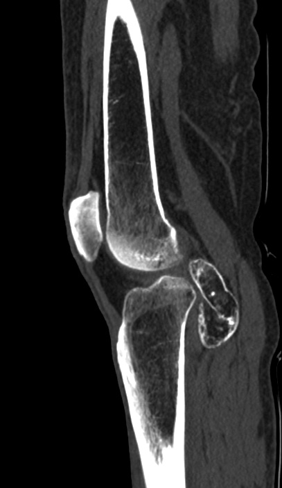 Calcified hematoma - popliteal fossa (Radiopaedia 63938-72763 Sagittal bone window 66).jpg
