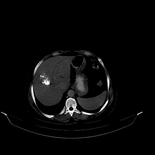 File:Calcified hydatid cyst of the liver (Radiopaedia 21212-21112 Axial bone window 12).jpg