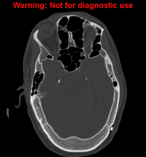Calvarial thickening from chronic shunting (Radiopaedia 60079-67637 Axial bone window 63).jpg