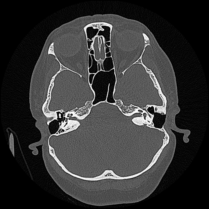 Canal up mastoidectomy (Radiopaedia 78108-90638 Axial bone window 77).jpg
