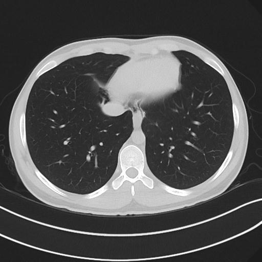 File:Cannabis ('bong') smoking induced pneumomediastinum and subcutaneous emphysema (Radiopaedia 29947-30479 C 59).jpg