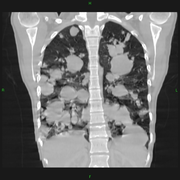 File:Cannon ball metastases - synovial sarcoma (Radiopaedia 26135-26271 Coronal lung window 14).jpg