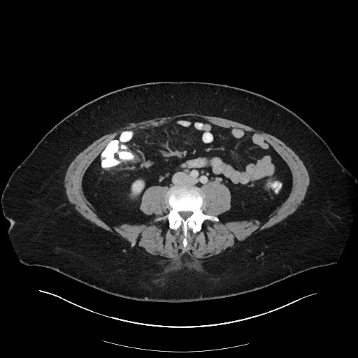 File:Carcinoid tumor - terminal ileum (Radiopaedia 60931-68739 A 79).jpg