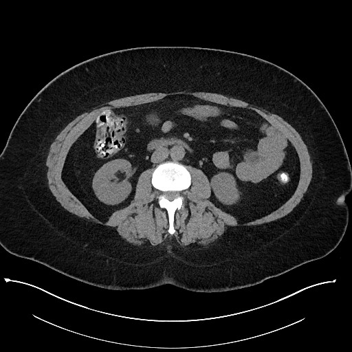 Carcinoid tumor - terminal ileum (Radiopaedia 60931-68740 Axial non-contrast 55).jpg
