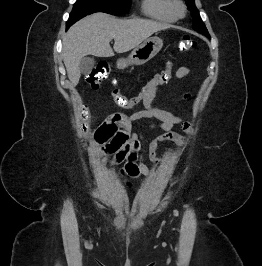Carcinoid tumor - terminal ileum (Radiopaedia 60931-68740 Coronal non-contrast 22).jpg