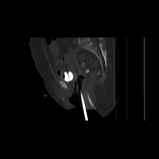 File:Carcinoma cervix- brachytherapy applicator (Radiopaedia 33135-34173 Sagittal bone window 93).jpg