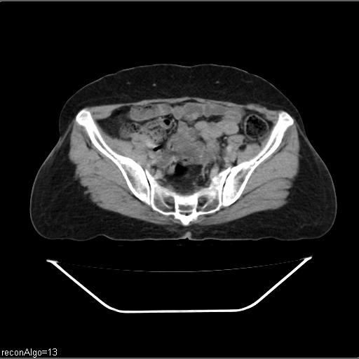 Carcinoma cervix- recurrence (Radiopaedia 34702-36137 B 41).jpg