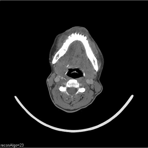 Carcinoma of the maxillary antrum (Radiopaedia 53805-59888 Axial C+ delayed 31).jpg