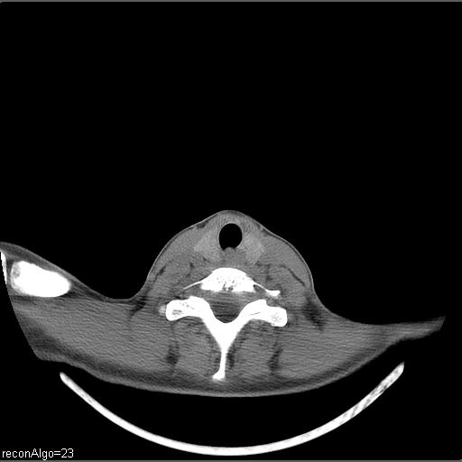 Carcinoma of the maxillary antrum (Radiopaedia 53805-59888 Axial non-contrast 16).jpg