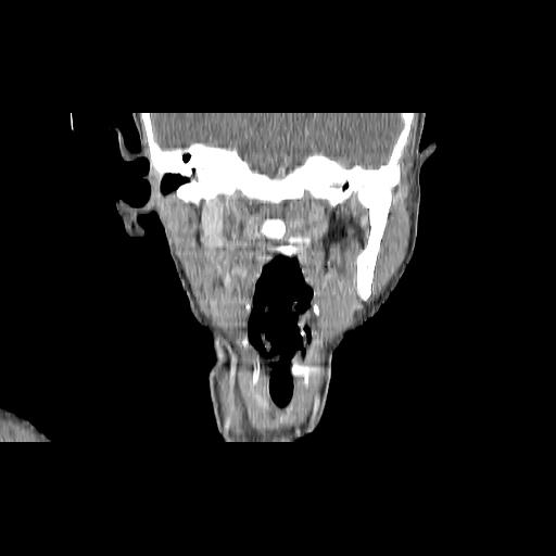 File:Carcinoma of the maxillary antrum (Radiopaedia 53805-59888 Coronal C+ delayed 92).jpg