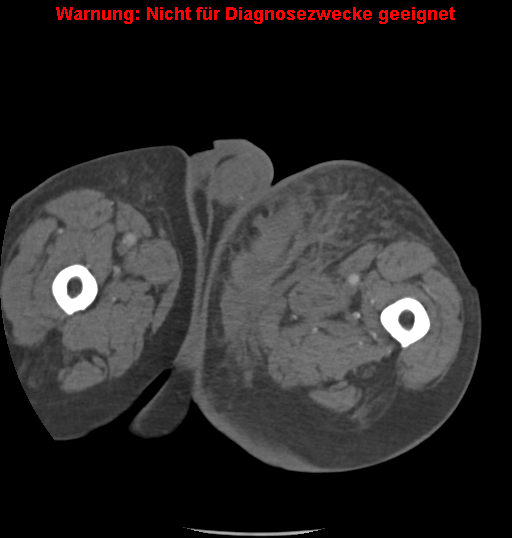 File:Cardiac perforation following transcatheter aortic valve implantation (Radiopaedia 23714-23863 B 34).png