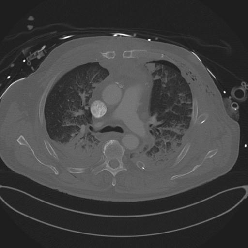 Cardiac trauma (Radiopaedia 32874-33858 Axial bone window 35).jpg