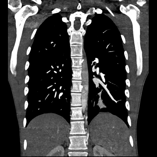 Cardiac tumor - undifferentiated pleomorphic sarcoma (Radiopaedia 45844-50134 Coronal non-contrast 49).png