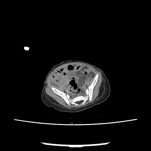 Caroli disease with autosomal recessive polycystic kidney disease (ARPKD) (Radiopaedia 89651-106703 E 194).jpg