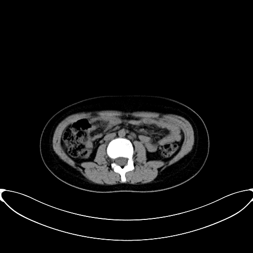 Caroli disease with medullary sponge kidney (Radiopaedia 82622-96804 Axial non-contrast 37).jpg