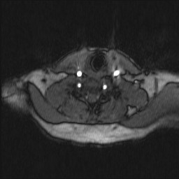 File:Carotid artery dissection (Radiopaedia 28441-28689 Axial MRA 22).jpg