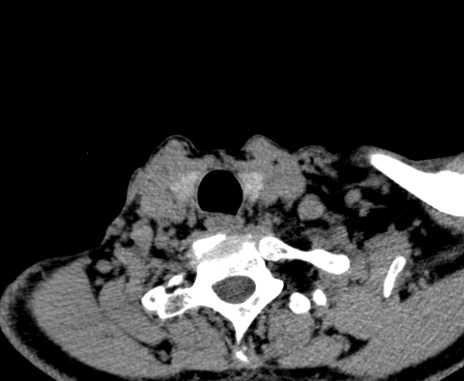 File:Carotid body tumor (Radiopaedia 61750-69757 Axial non-contrast 99).jpg