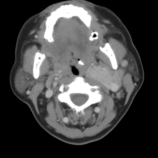 File:Carotid body tumor (paraganglioma) (Radiopaedia 38586-40729 A 13).jpg