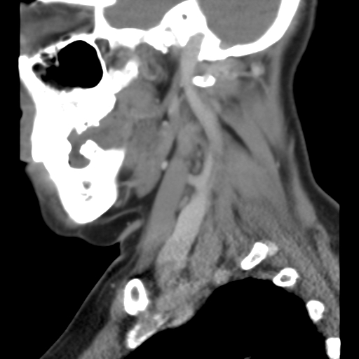 File:Carotid body tumor (paraganglioma) (Radiopaedia 38586-40729 C 11).jpg