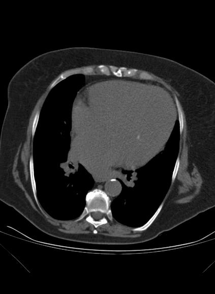 File:Caseous mitral annular calcification (Radiopaedia 61219-69122 Axial non-contrast 9).jpg