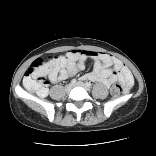 Castleman disease with fibrous pseudotumor in the abdomen (Radiopaedia 77296-89373 A 80).jpg