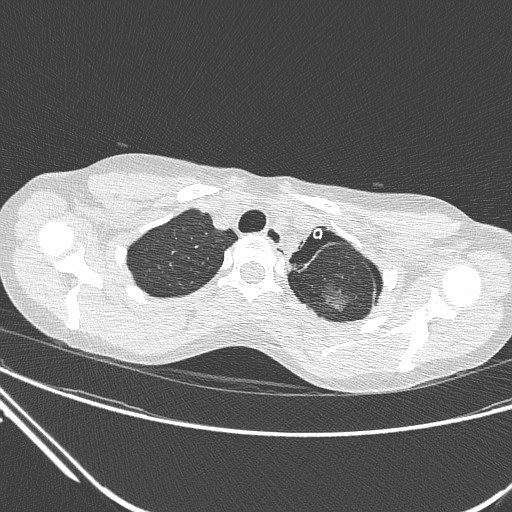 File:Catamenial pneumothorax (Radiopaedia 27946-28197 lung window 32).jpg
