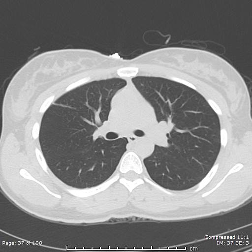 Catamenial pneumothorax (Radiopaedia 54382-60600 Axial non-contrast 37).jpg