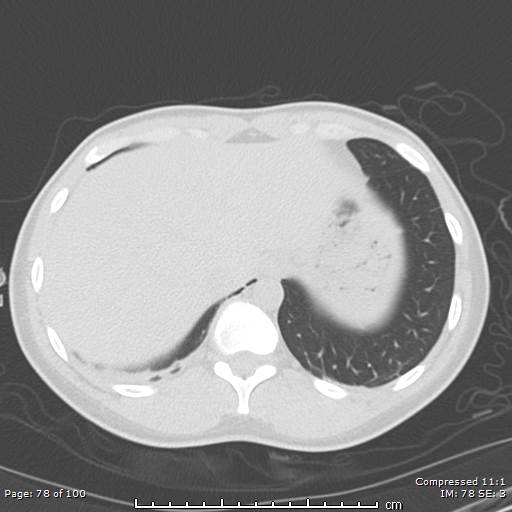 Catamenial pneumothorax (Radiopaedia 54382-60600 Axial non-contrast 78).jpg