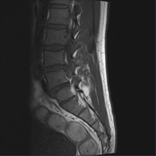 File:Cauda equina syndrome (Radiopaedia 53615-59672 Axial T1 7).png