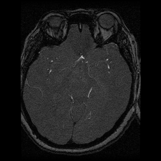 Cavernoma, DVA and right ICA aneurysm (Radiopaedia 33890-35072 E 42).png