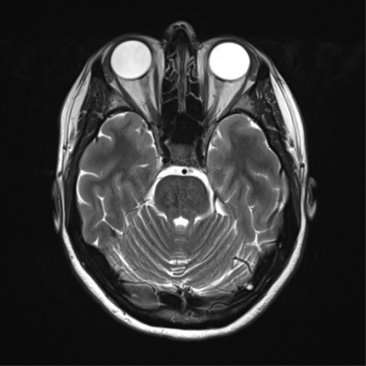 File:Cavernoma with bleed - midbrain (Radiopaedia 54546-60773 Axial T2 13).png