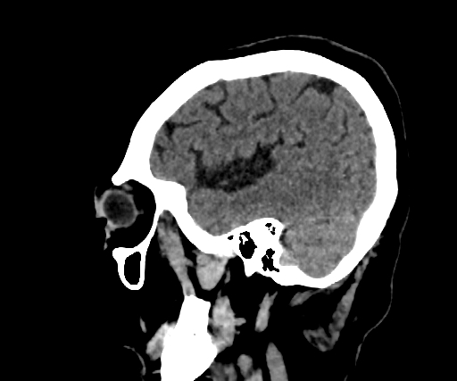 Cavernous hemangioma of the cerebellar falx (Radiopaedia 73025-83723 B 73).jpg