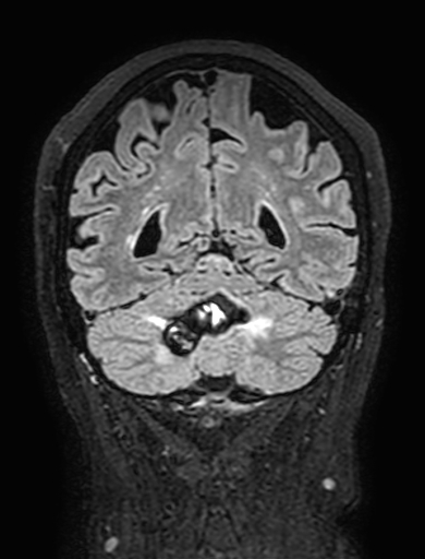 Cavernous hemangioma of the cerebellar falx (Radiopaedia 73025-83724 Coronal FLAIR 259).jpg